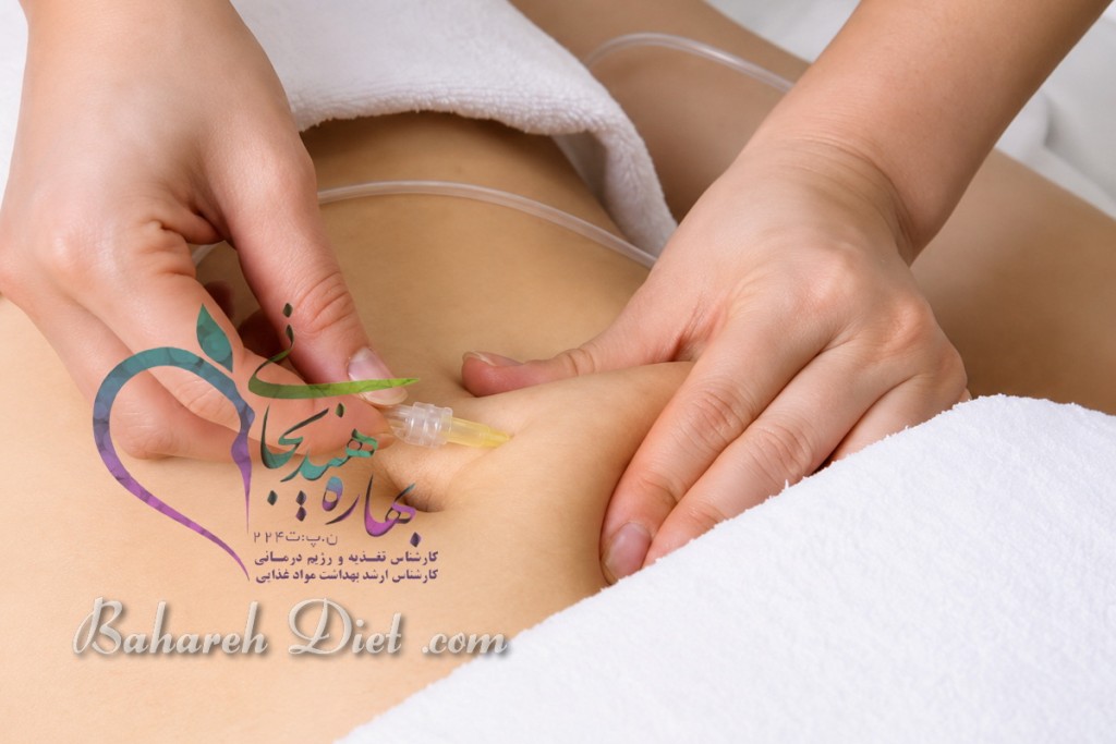 کربوکسی تراپی شکم