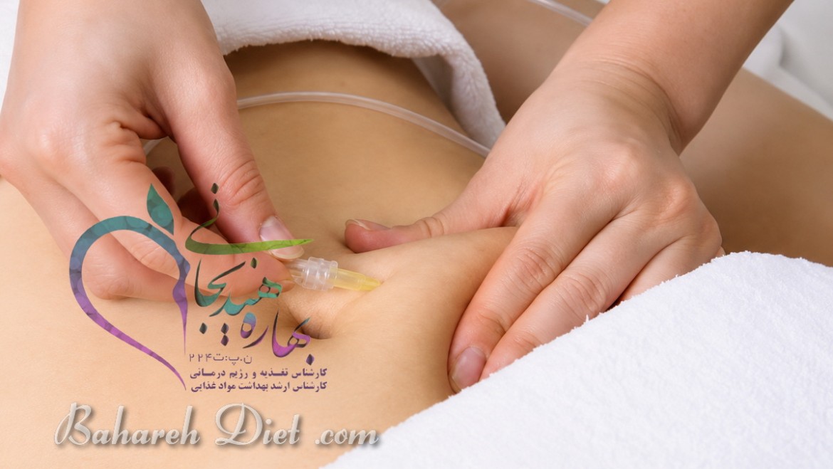 کربوکسی تراپی شکم